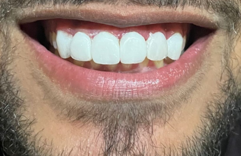 SORRISO POR DR HIAGO DANTAS