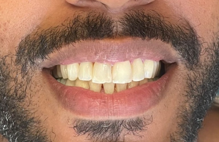 SORRISO POR DR HIAGO DANTAS
